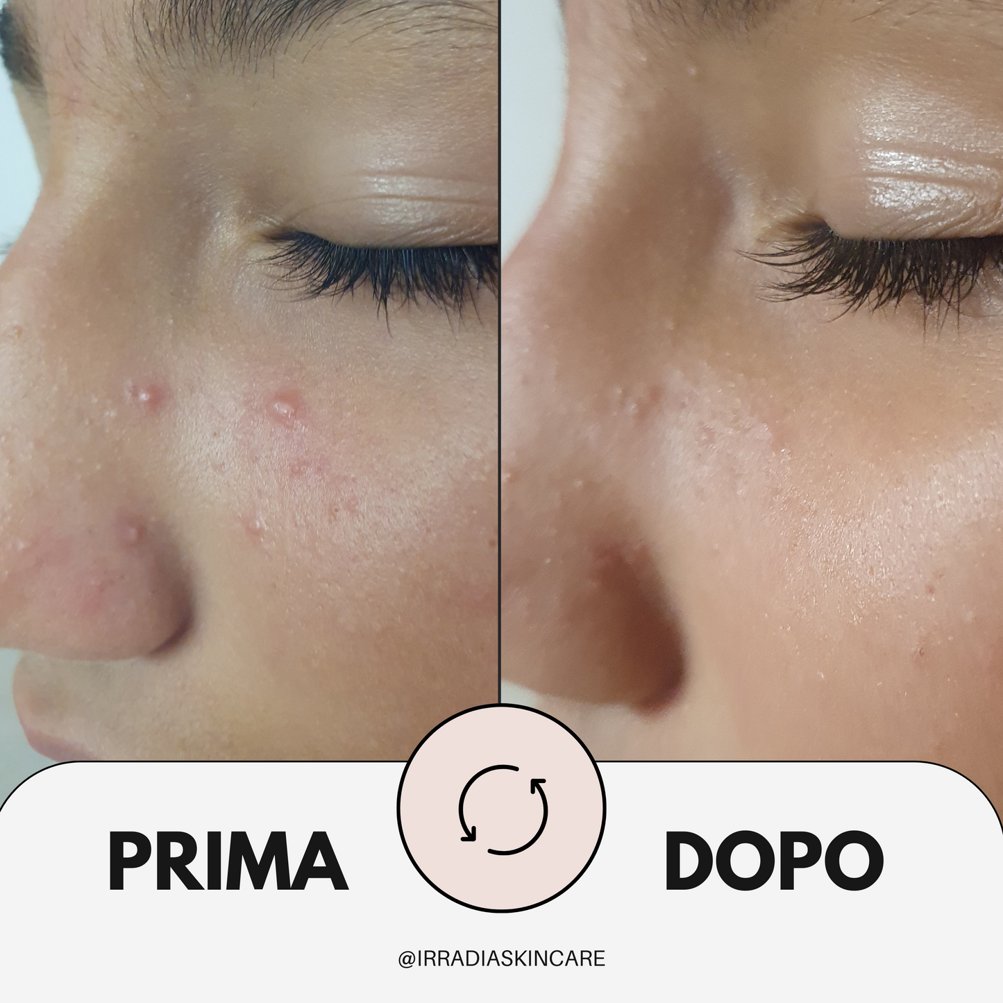 PURA - Siero Esfoliante/Normalizzante 30 ml